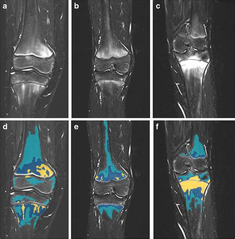 Bone Marrow Signal Was Divided Into Three Intensity Levels