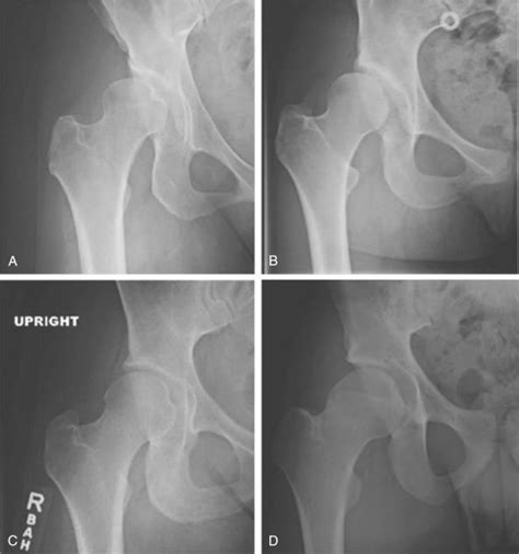 Hip Dysplasia And Instability Clinical Tree