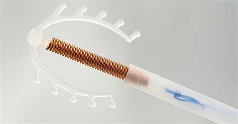 Mirena iud removal – Artofit