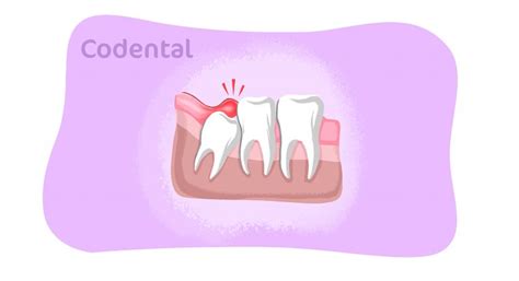 Pericoronarite Saiba Mais Sobre O Tratamento Causas E Sintomas