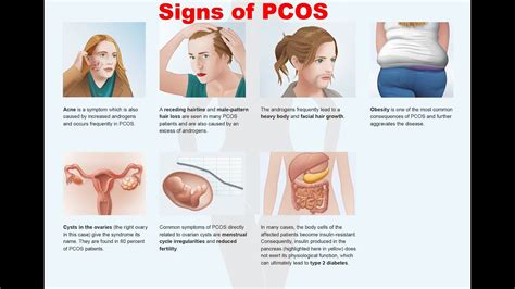 Obesity And Pcos Understanding The Correlation With Dr Shashank Shah