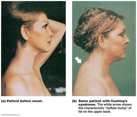 Top 105 Pictures Cushings Syndrome Cushings Disease Before And After