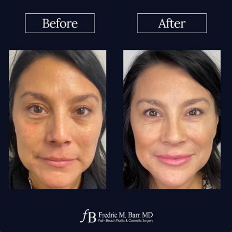 Derma Filler Palm Beach Plastic Cosmetic Surgery