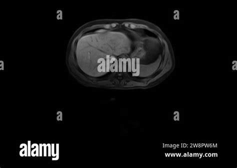 Ct Scan Of The Abdomen Computed Tomography Of The Gastrointestinal