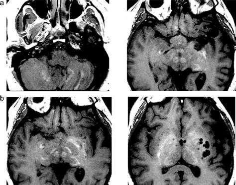 T1-weighted enhancement on MRI imaging of the GP and DN. T1-weighted ...