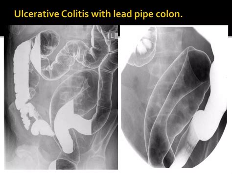 Extraintestinal Manifestations Of Ibd Inflammatory Bowel Disease A