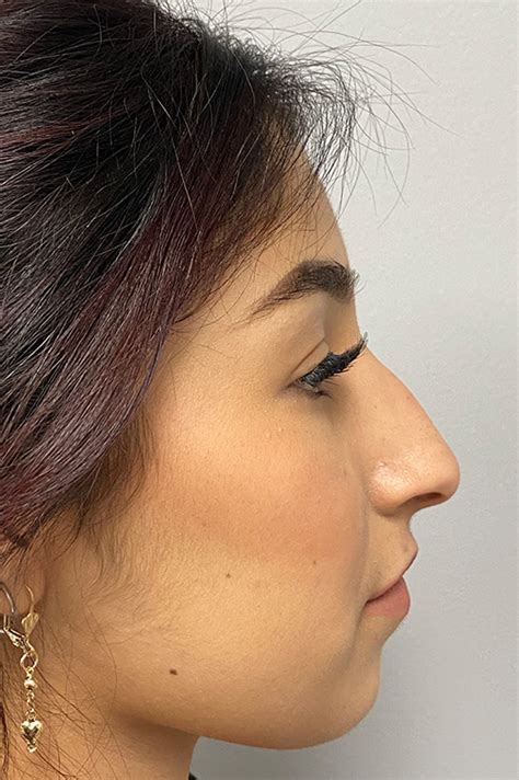 Los Angeles Rhinoplasty Before After Photos Patient 24 Dr Aminpour