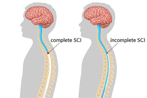 C8 Spinal Cord Injury What To Expect And How To Recover