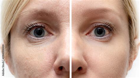 Woman Face With Wrinkles And Age Change Before And After Treatment