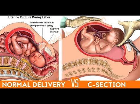 Cesarean Section Technique With Diagram