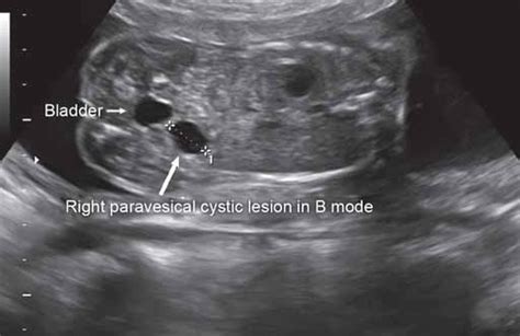 A Paraureteral Or Hutch Diverticula Are Congenital Bladder Diverticula