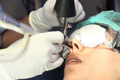 Laser Surgery To Cure Sneezing Dr Paulose