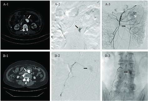 The Cases Of Secondary Intervention For The Type II Endoleaks A 1 The