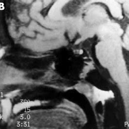 A Fast Spin Echo T2 Weighted Coronal MRI Of The Sella B Spin Echo