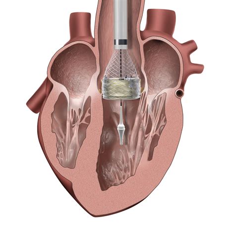 Transaortic Valve Replacement