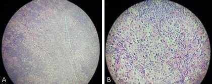 A Biopsia De Ganglio Cervical Neoplasia Maligna Epitelioide Con