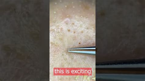 Pimple Popping 2022 New Blackheads On Nose Pimple Popping Tiktok