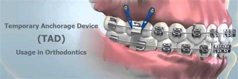 Temporary Anchorage Device TAD Usage In Orthodontics With Video