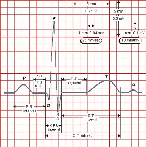 Understanding Ekg