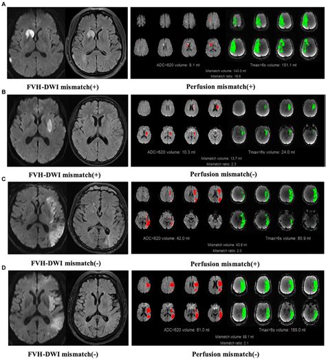 Frontiers Comparison Between Mri Flair Vascular Hyperintensity Dwi