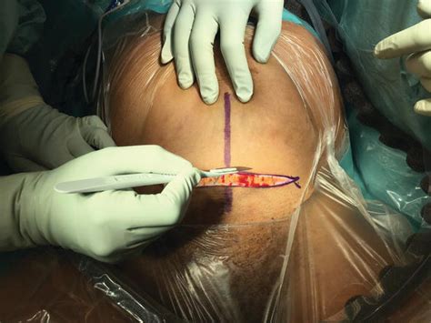 Cesarean Section Procedure