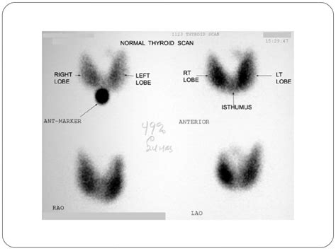 Radionuclide Imaging Thyroid And Parathyroid