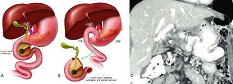 Whipple Procedure Animation