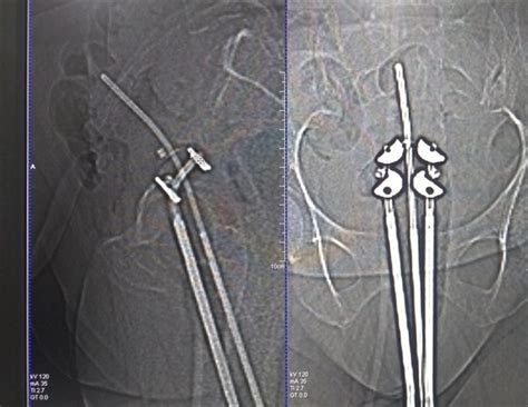 Brachytherapy for Prostate Cancer