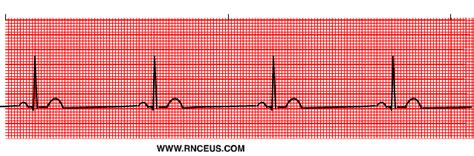 Sinus Bradycardia Ekg Strip