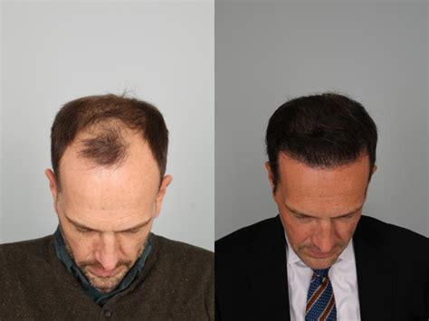 Neograft Hair Transplant Before And After Photo Gallery Louisville Ky