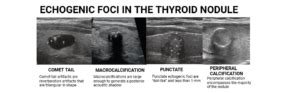 Tirads Calculator For Thyroid Nodules My Endo Consult