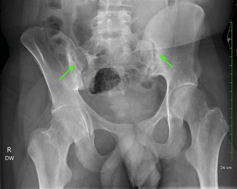 Bilateral hip and sacroiliac joint X-ray demonstrating joint space ...