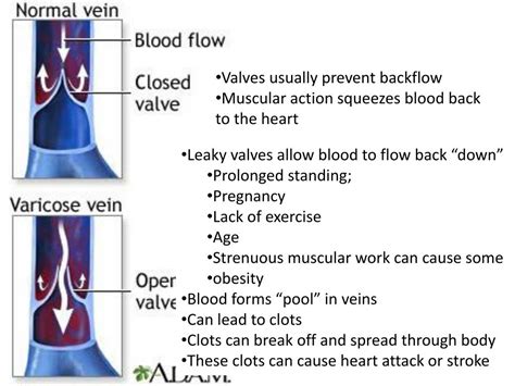 PPT - Vein valves and varicose veins PowerPoint Presentation, free ...