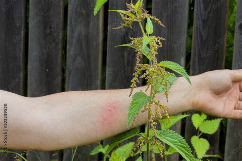 Stinging Nettle Blisters