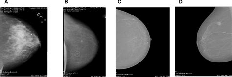 Frontiers Breast Cancer Detection Shallow Convolutional Neural