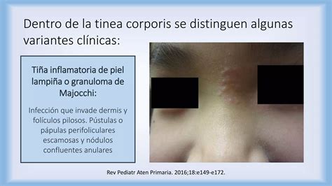 Dermatofitosis Tiñas Ppt