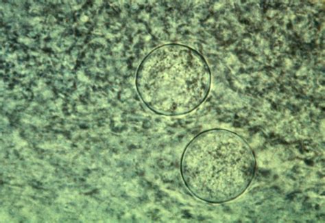 Coccidioidomycosis Laboratory Tests Wikidoc