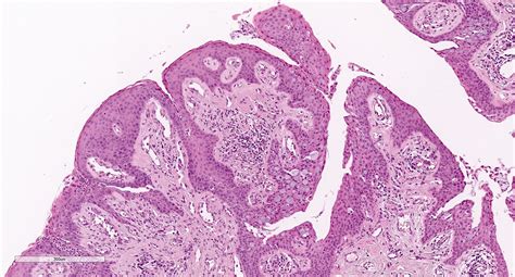 Conjunctival Squamous Papilloma