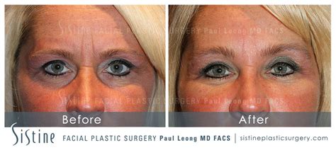 Restylane Juvederm Before And After 44 Sistine Facial Plastic Surgery