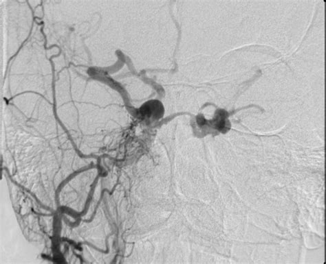 Dural Arteriovenous Fistulas | Brazil | PDF | PPT| Case Reports ...