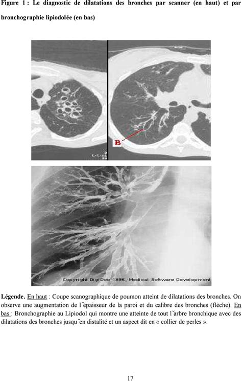 Mécanismes De L Angiogénèse Bronchique Et De La Synthèse De Vegf Par L