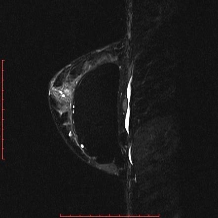 Intracapsular Breast Implant Rupture Image Radiopaedia Org