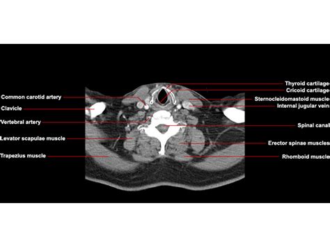 Ct Neck Axial Anatomy Radiologypicscom