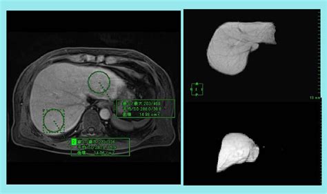 Figure From Analysis Of Functional Partial Liver Volume Evaluations