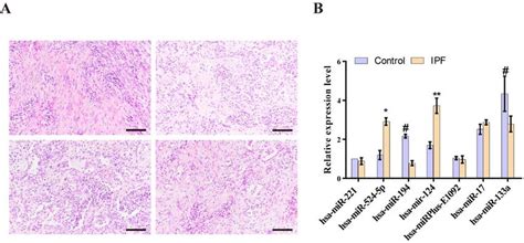 Biomarkers Are Significantly Expressed In The Lung Tissues Of Patients