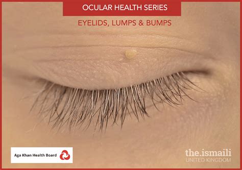 Eyelid Lumps And Bumps Theismaili