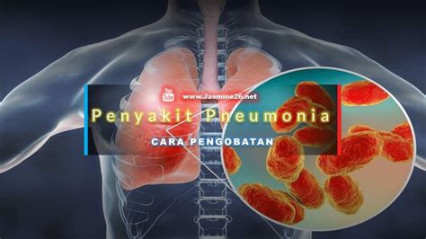 Cara Pengobatan Penyakit Pneumonia Penyakit Streptococcus Pneumoniae