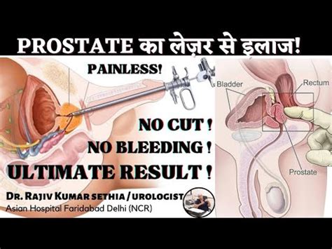 Treatment Of Prostate By Lazer Painless Dr