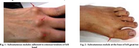 Subcutaneous Nodules Rheumatoid Arthritis