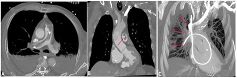 Diagnostics Free Full Text Ct Imaging Findings Of Pulmonary Artery Stenosis A Pictorial Review